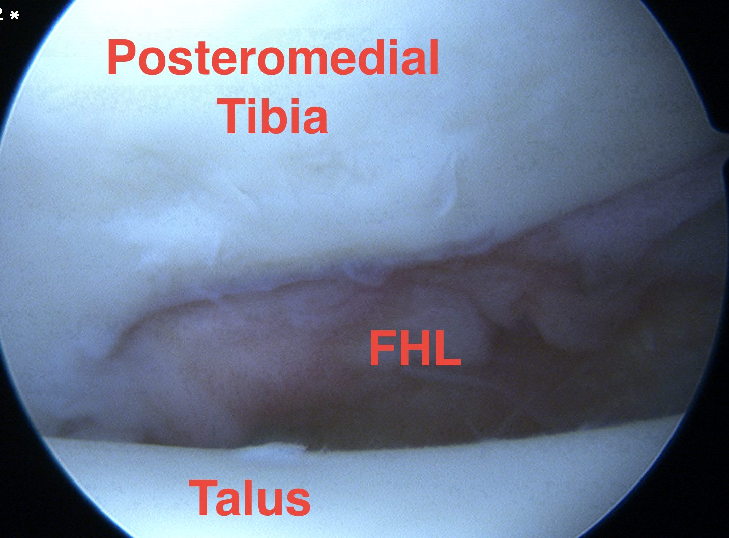 Ankle Scope Posteromedial Capsule